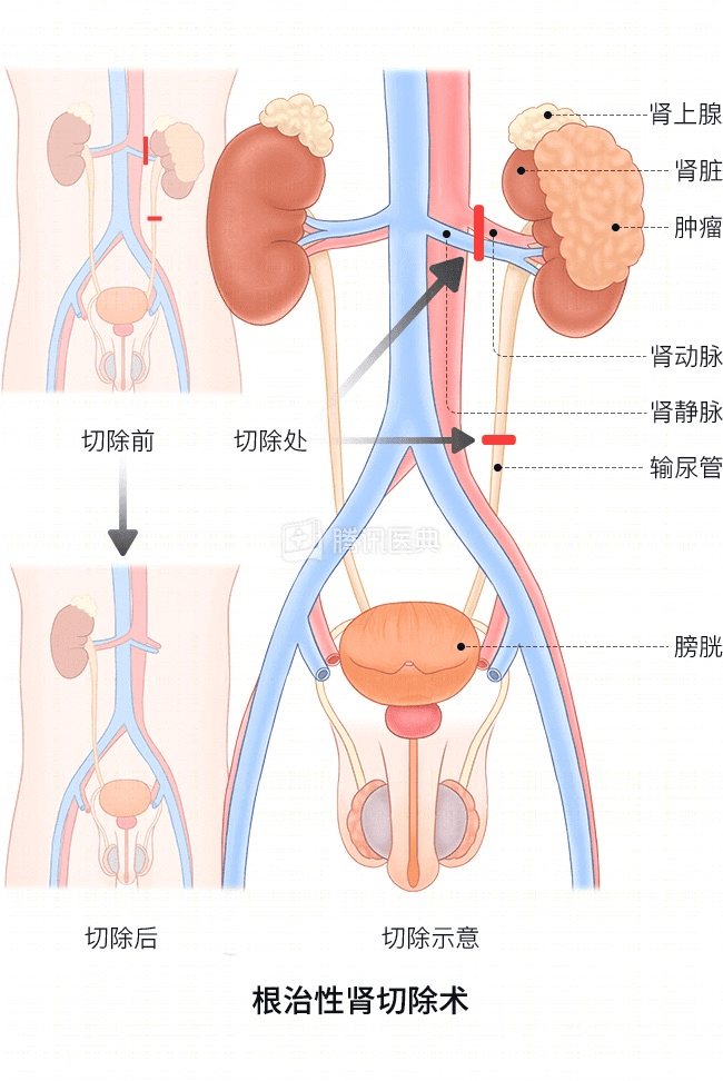 “感觉天塌了”！深圳女孩5岁患癌，爸妈决定：为她冻存卵巢组织